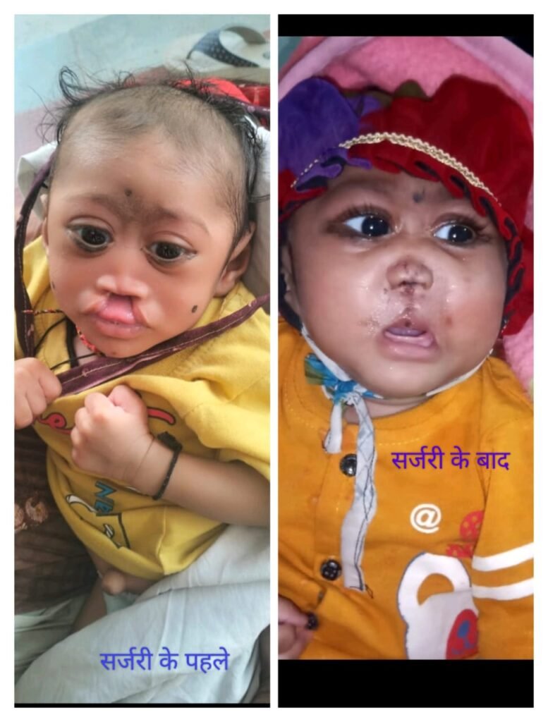 राजगढ़। कटे होंठ की विकृति से जूझ रहे ऋतिक को मिली नई मुस्कान