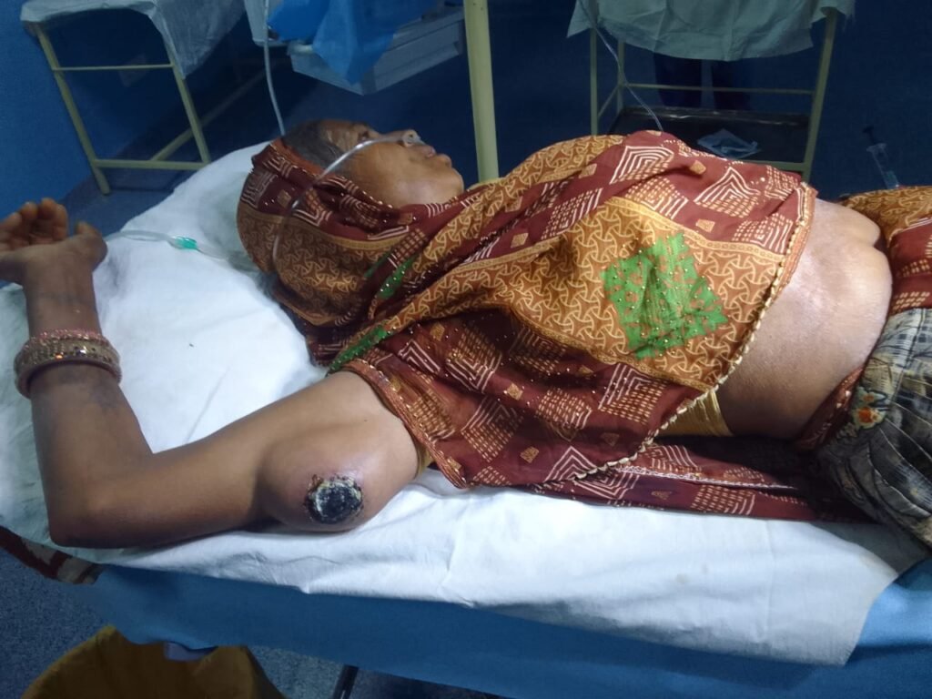 राजगढ़। 6 साल पुरानी गांठ का जिला अस्पताल में सफल ऑपरेशन